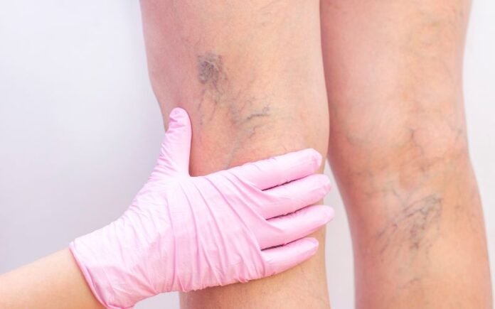 varicose veins