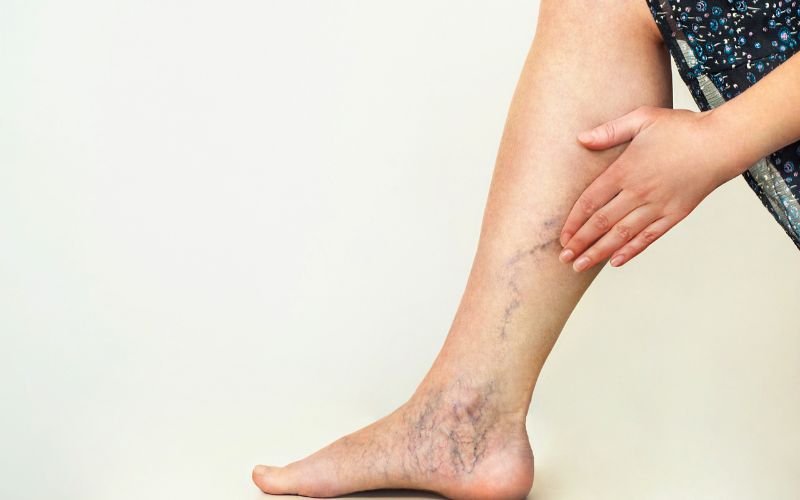 varicose veins 2